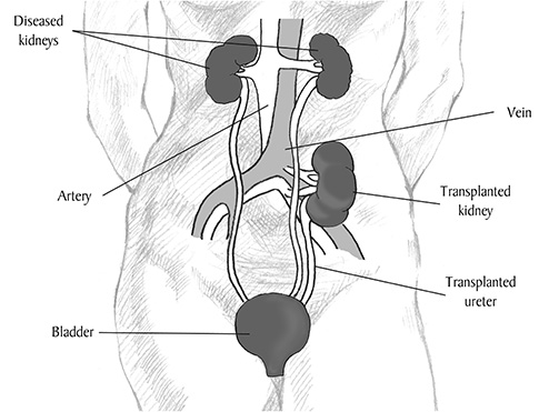 Kidney and Pancreas Transplantation | Weill Cornell Medicine