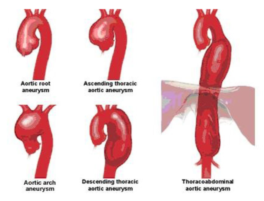 Aortic Aneurysm And Dissection Repair Weill Cornell Medicine