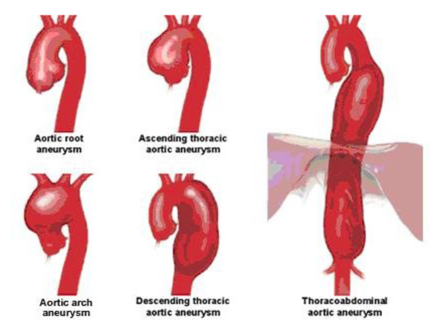 Aorta Artery Aneurysm