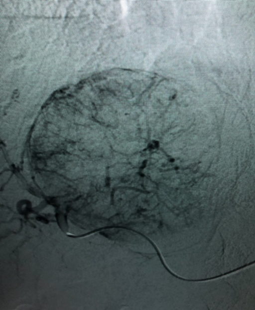 Cancer Treatments (Interventional Oncology) - Photo 1